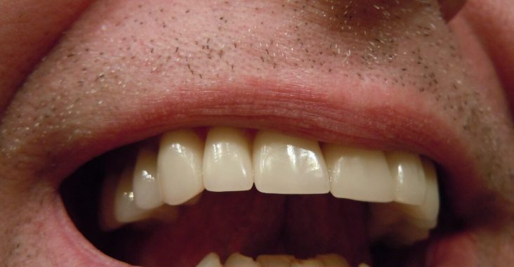 Jak usunąć przebarwienia na zębach - domowe sposoby